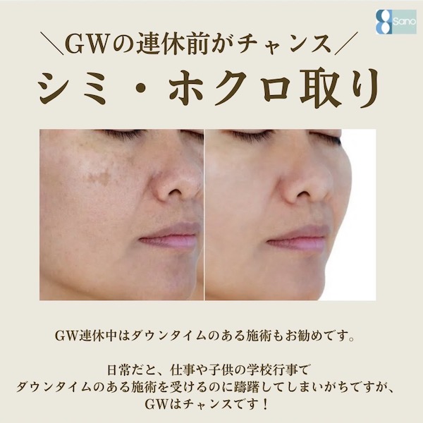 GWの連休前にシミ取りレーザーしませんか?✨️