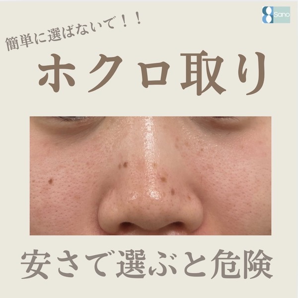 ホクロ・シミ・イボ除去はさの皮膚科クリニックにお任せください👩🏻⚕️🩺✨