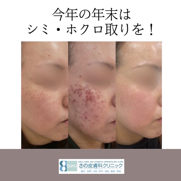 皆さんも年末年始の休み前に気になっていたシミを綺麗にしませんか?✨