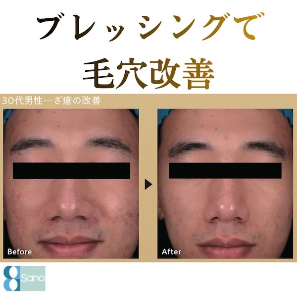 ブレッシングで毛穴改善🌱