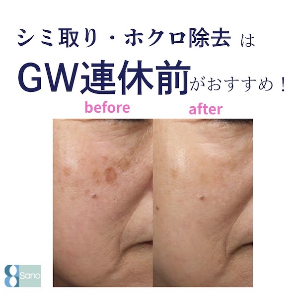 大型連休前は特に、シミ取りやホクロ除去を希望される方が多いです💡