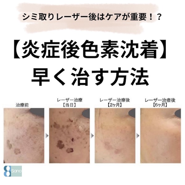 シミ取りレーザー後はケアが重要！
