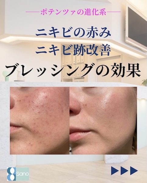 ニキビの赤み・ニキビ跡に悩んでいる方👀